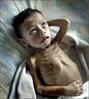 child malnutrition P1XAs 3868