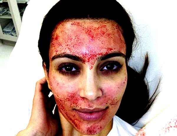 kim-kardashian-vampire-facial