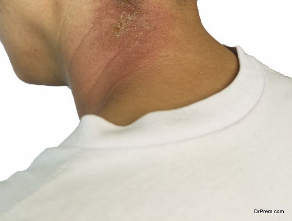  skin-diseases