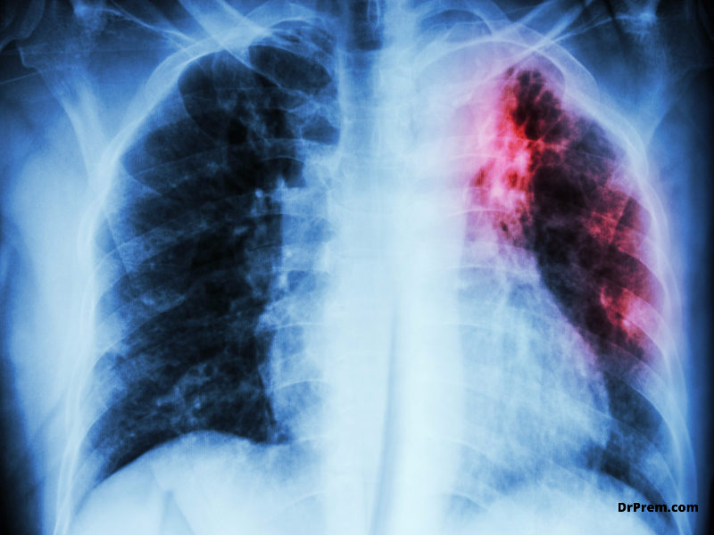 Reasons favoring the rise in drug-resistant TB