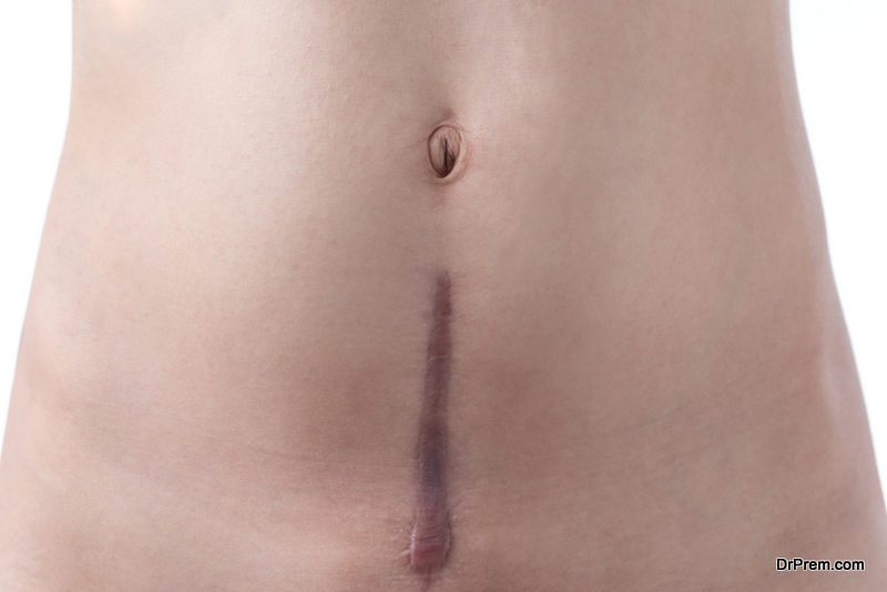Your Stomach After C-Section