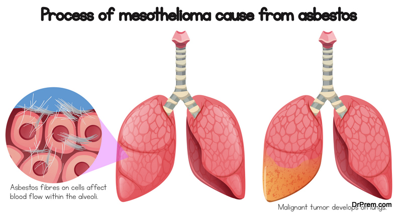 Mesothelioma and it’s Relation with Asbestos